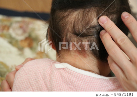 ウンナ母斑、赤ちゃん、皮膚病、赤、あざ ウンナ母斑、赤ちゃん、皮膚病、赤、あざ 94871191