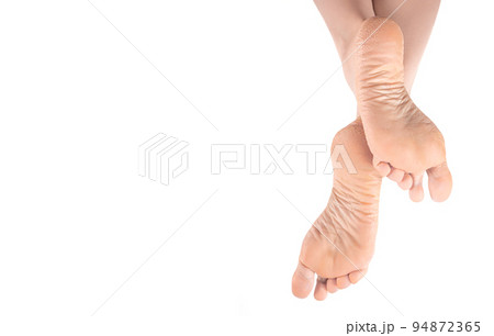 Dry and cracked soles of feet. female legs, feet, foot in an elegant position isolated on white background. feet heels needs skin care Dry and cracked soles of feet. female legs, feet, foot in an elegant position isolated on white background. feet heels needs skin care 94872365
