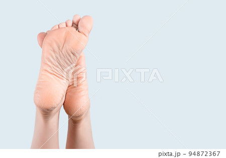 Dry skin on heel. Dry and cracked soles of feet on gray background, foot with dry heels, cracked skin heel of foot with bad skin is covered with cracks. Dry skin on heel. Dry and cracked soles of feet on gray background, foot with dry heels, cracked skin heel of foot with bad skin is covered with cracks. 94872367