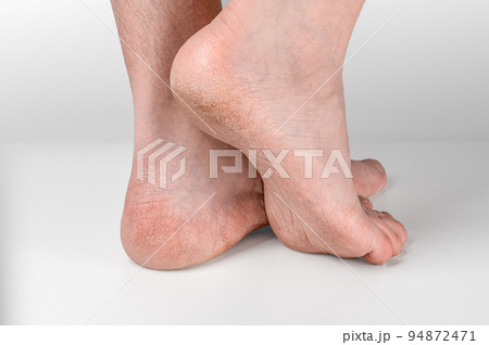 Dry and cracked soles of feet on gray background, foot with dry heels, cracked skin heel of foot with bad skin is covered with cracks 94872471