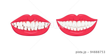 Healthy straight and diseased crooked teeth 94888753