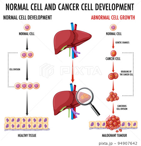 Diagram showing normal and cancer cell Diagram showing normal and cancer cell 94907642