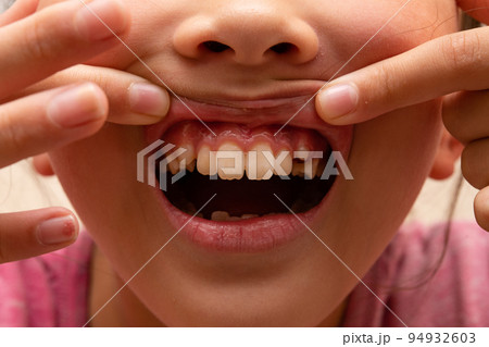 歯が抜けた子供 94932603