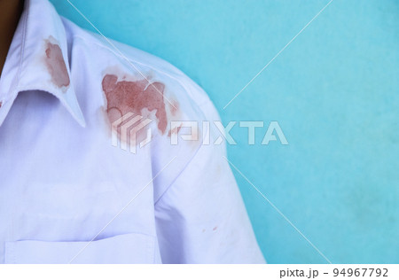 Dirty blood stain on kid shirt from accident in playing in life activity. dirty stain for cleaning concept. 94967792