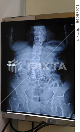 X-ray film on X-Ray viewer. X-ray film on X-Ray viewer. 94997971