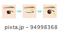 まぶたの脂肪取り 94998368