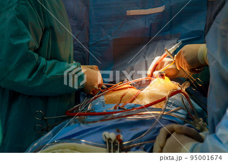 A coronary artery bypass graft CABG is performed for heart operations caused by coronary heart disease in the operating room of a hospital 95001674