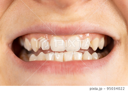 Patient with malocclusion, gap between upper and lower teeth, close-up mouth. 95034022