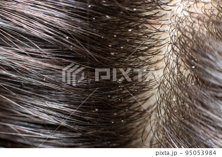 Macro photo dander on dark brunette hair. The problem of dried scalp, wrong shampoo, fungus on the head Macro photo dander on dark brunette hair. The problem of dried scalp, wrong shampoo, fungus on the head 95053984