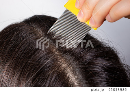A brunette woman with pediculosis cleans her hair from lice and nits with a comb with small prongs. A lice comb. 95053986
