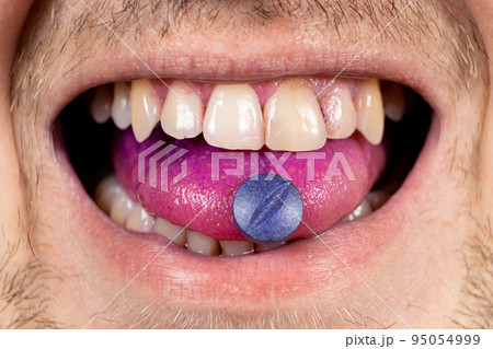 A person shows an indicator pill on his tongue to determine plaque. A person shows an indicator pill on his tongue to determine plaque. 95054999