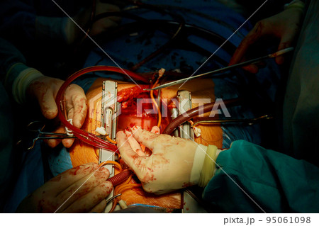 Due to malfunctioning heart valve, open heart surgery is required for during the procedure valve replacement 95061098