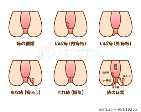 痔の症状の種類の図解イラスト素材セット 95119255