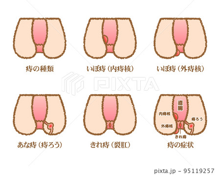 痔の症状の種類の図解イラスト素材セット2 痔の症状の種類の図解イラスト素材セット2 95119257