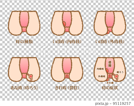 痔の症状の種類の図解イラスト素材セット2 痔の症状の種類の図解イラスト素材セット2 95119257