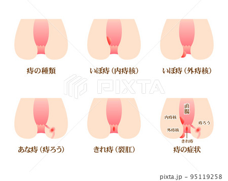 痔の症状の種類の図解イラスト素材セット3 95119258