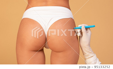 Closeup of surgeon drawing marks on female butts, preparing for cosmetic operation, beige studio background, back view Closeup of surgeon drawing marks on female butts, preparing for cosmetic operation, beige studio background, back view 95133252