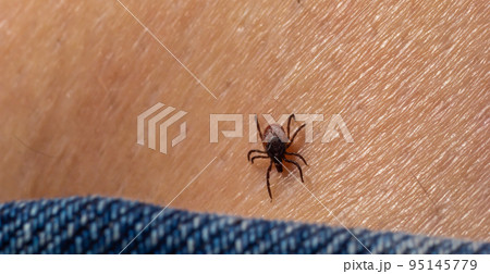 The parasite mite sits on a persons skin. infection carrier. Ixodes ricinus The parasite mite sits on a persons skin. infection carrier. Ixodes ricinus 95145779