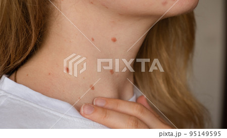 Unrecognizable woman showing her Birthmarks on neck skin Close up detail of the bare skin Sun Exposure effect on skin, Health Effects of UV Radiation Woman with birthmarks Pigmentation 95149595