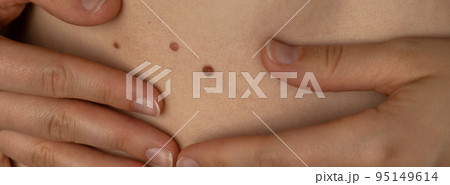 Unrecognizable woman showing her Birthmarks on skin Close up detail of the bare skin Banner Sun Exposure effect on skin, Health Effects of UV Radiation Woman with birthmarks Pigmentation Unrecognizable woman showing her Birthmarks on skin Close up detail of the bare skin Banner Sun Exposure effect on skin, Health Effects of UV Radiation Woman with birthmarks Pigmentation 95149614