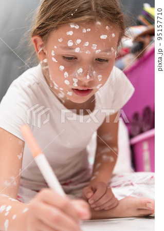 Little school girl with chickenpox drawing on white board in kids' room, antiseptic cream applied to face and body. Chalkboard and toys background.  95157710