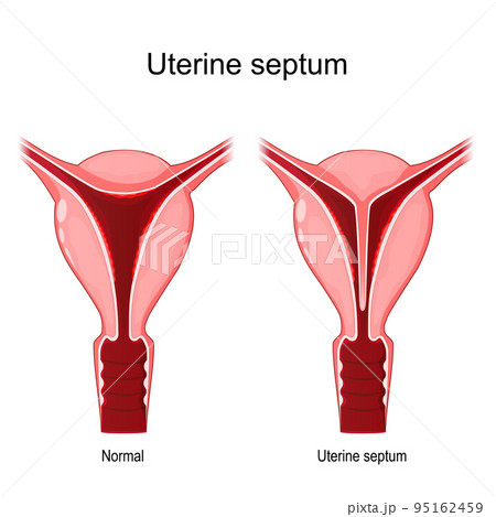 Uterine septum. 95162459