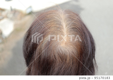 薄毛　女性　白髪　日本人 95170183
