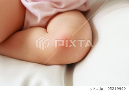 baby skin rash and allergy with red spot cause by mosquito bite at knee 95219990