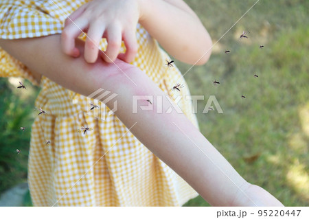 Little girl has skin rash allergy and itchy on her arm from mosquito bite 95220447