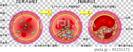 動脈硬化　イラスト　日本語 95231172