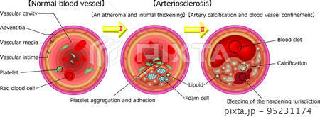 動脈硬化　イラスト　英語 95231174