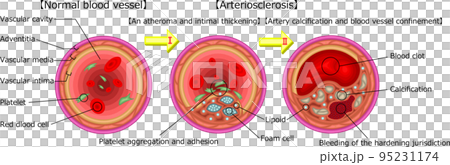動脈硬化　イラスト　英語 95231174