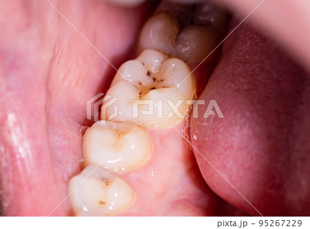 Caries in the mouth on the chewing teeth. Installation of high quality dental fillings. Dental treatment in modern dentistry, macro Caries in the mouth on the chewing teeth. Installation of high quality dental fillings. Dental treatment in modern dentistry, macro 95267229