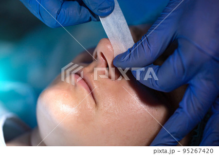 Doctor cosmetologist performs plastic surgery to correct the shape of the nostrils and nose of the patient's girl. Rhinoplasty, elimination of the siddle shape of the nose 95267420