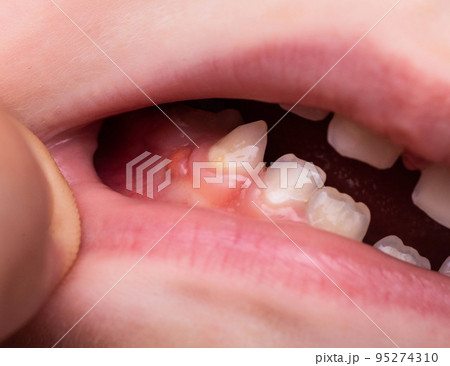 A bump is a tumor on the tooth gum in a child. Periodontitis in children due to a tooth with pulpitis. Close-up 95274310