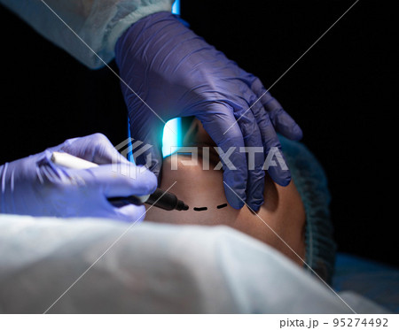 Plastic surgery to correct and remove a double chin in a female patient. Mentoplasty, close-up 95274492