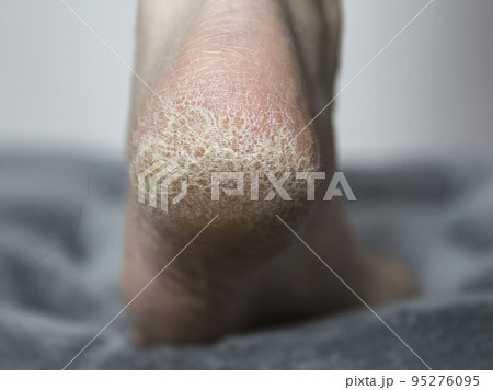 dry skin with cracks on the heel of the foot in a person, close-up. Treatment of hardened and cracked skin, dermatology 95276095