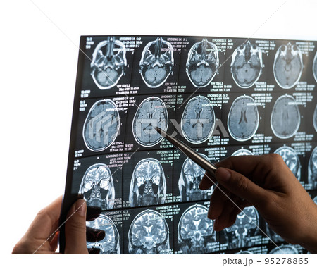 A female doctor examines an MRI scan of the brain. A female doctor examines an MRI scan of the brain. 95278865