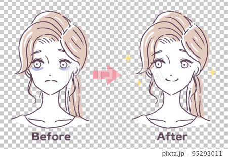 黑眼圈治療前後 患有黑眼圈的女人 失眠 睡眠不足 人物插圖素材 95293011