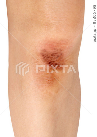 脚の膝の怪我、カサブタ 脚の膝の怪我、カサブタ 95305798