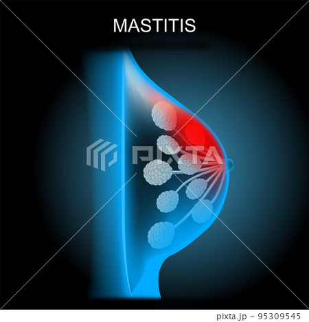 Mastitis. x-ray image blue scanning of a breast Mastitis. x-ray image blue scanning of a breast 95309545