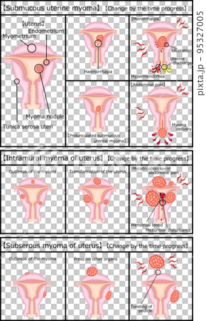 Types and progress of uterine fibroids Illustration English Types and progress of uterine fibroids Illustration English 95327005