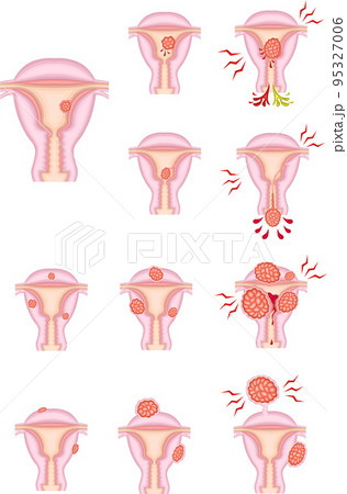 子宮筋腫の種類と経過　イラスト 95327006