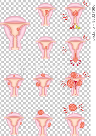 Types and progress of uterine fibroids illustration 95327006