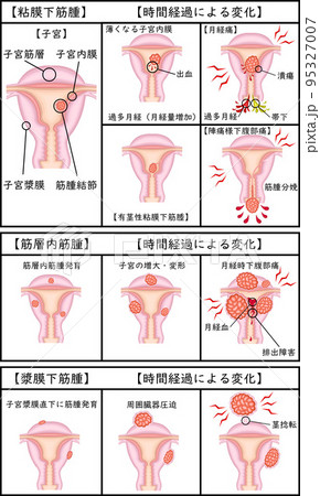 子宮筋腫の種類と経過 イラスト 日本語 子宮筋腫の種類と経過 イラスト 日本語 95327007