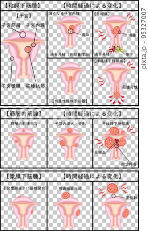 子宮筋腫の種類と経過 イラスト 日本語 子宮筋腫の種類と経過 イラスト 日本語 95327007