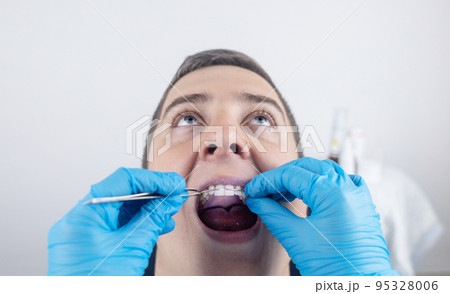 Installation of braces, bridges and a dental plate to correct teeth. An orthodontist installs a bracket system on an uneven jaw. Implants and smile correction. Concept of working in the dentist office Installation of braces, bridges and a dental plate to correct teeth. An orthodontist installs a bracket system on an uneven jaw. Implants and smile correction. Concept of working in the dentist office 95328006