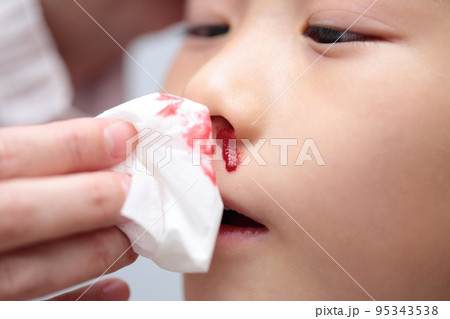 鼻血が出る小学生の女の子 (血のりでイメージ) 鼻血が出る小学生の女の子 (血のりでイメージ) 95343538