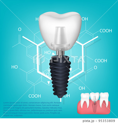 Vector Realistic Tooth. Structural Elements Of...のイラスト素材 [95353809] - PIXTA