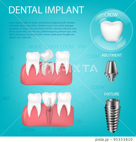 Vector realistic, 3D set of dental implants with installation in the gum. Structural elements of dental implant isolated with text. 95353810